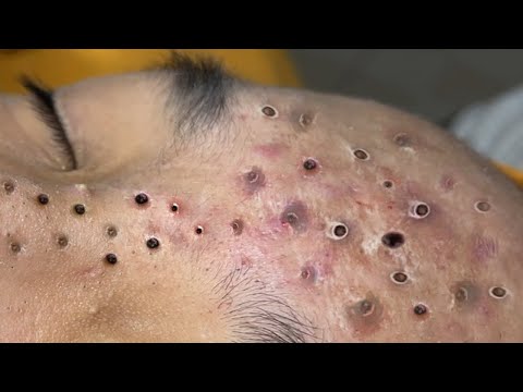 The Viral 2021 Blackhead Removal Video Everyone's Talking About (Loan Nguyen)