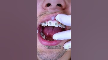 IPR (Interproximal Reduction) of one tooth to make it more narrow w/ TheBracesDoc