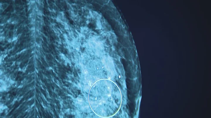 FDA sets new guidelines for mammograms