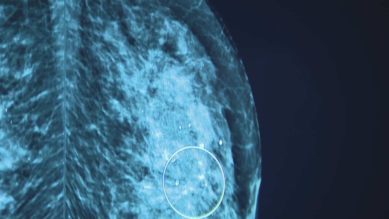 FDA sets new guidelines for mammograms