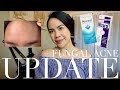 6 MONTH UPDATE ON MY FUNGAL ACNE | jskavee