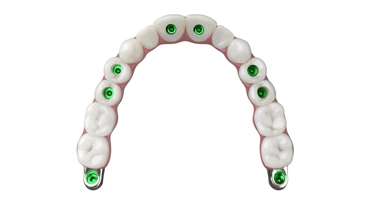 Roott Open Implant System