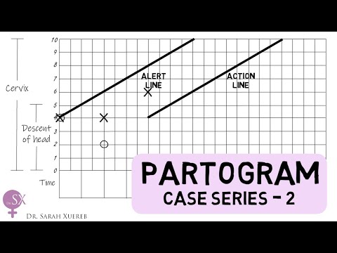 Partogram - Case Series 2