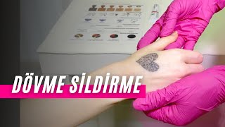 Dövme Sildirme | Antalya | DK Klinik
