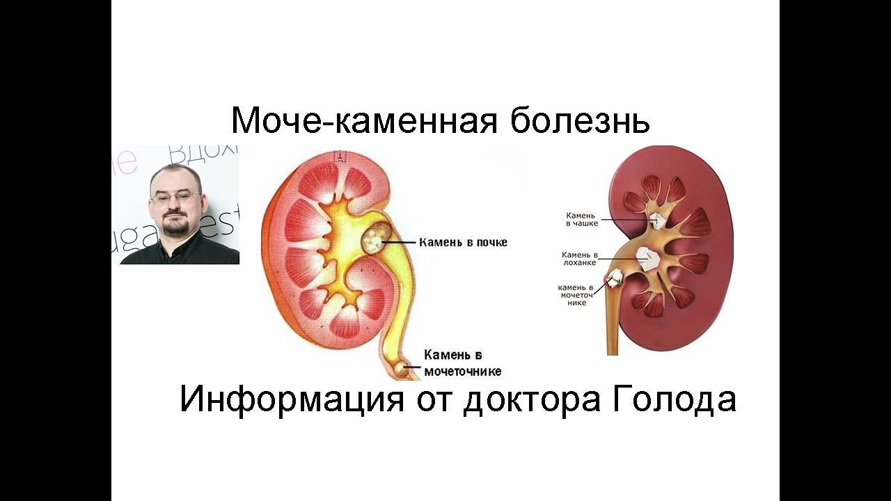 Мочекаменная болезнь - YouTube