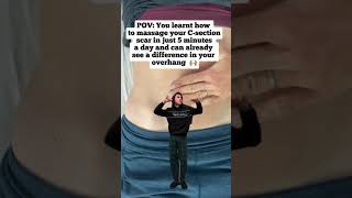 How to get rid of your C-section overhang the360mama.com #newmom #csectionoverhang #csectionmom