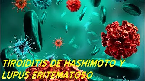 ¿Es lo mismo el Hashimoto que el lupus?