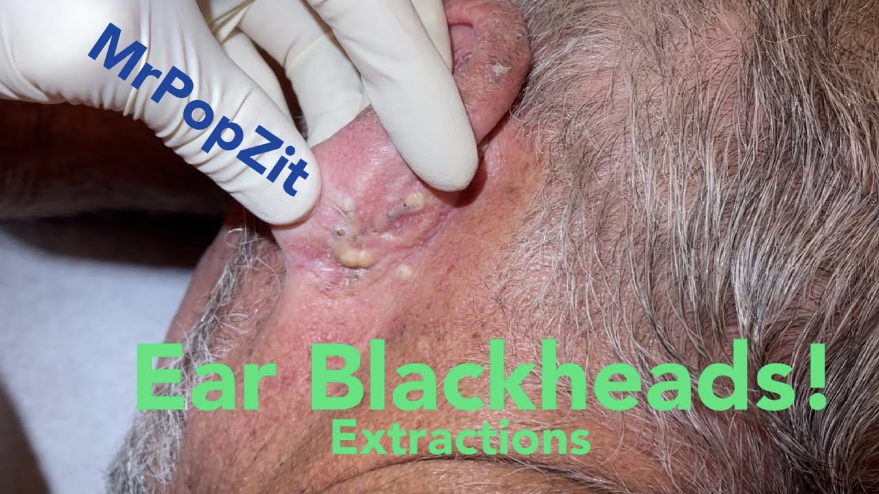 Ear Blackhead extractions. Multiple techniques used for deep embedded dry plugs and cyst pops.