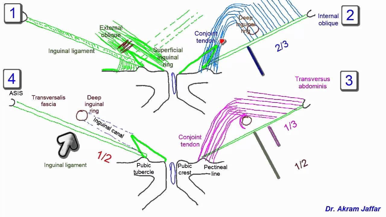 The secondary external inguinal ring and associated fascial planes:  surgical anatomy, embryology, applications | Hernia