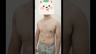 Вакуумная Терапия Воронкообразной Деформации У Пациентов Старше 20 Лет