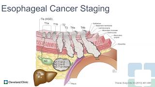 T1b Esophageal Cancer – Should Endoscopic Resection be Considered?