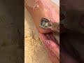 Crazy callus removal shaving clipping asmr pedicure  hyperkeratosis eppk foot  dec 12 2023