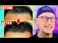 Hair Restoration Surgery | Are the Latest Techniques Really Better?