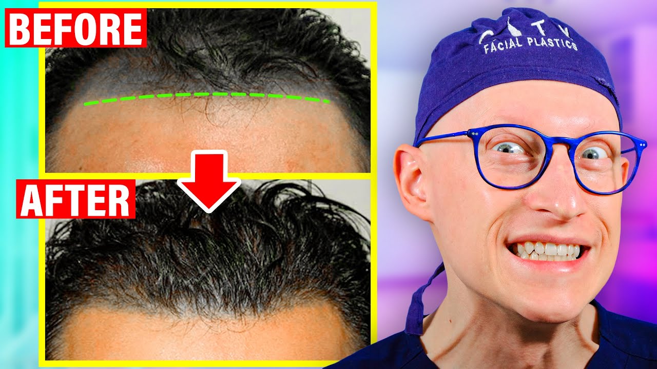 This is the BIGGEST Hair Restoration Change