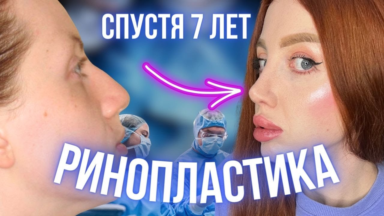 РИНОПЛАСТИКА СПУСТЯ 7 ЛЕТ - ВСЯ ПРАВДА. ПОСЛЕДСТВИЯ, НОС КАРТОШКОЙ, ОСЛОЖНЕНИЯ