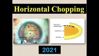 Horizontal phaco chopping (basic phaco ) # 008