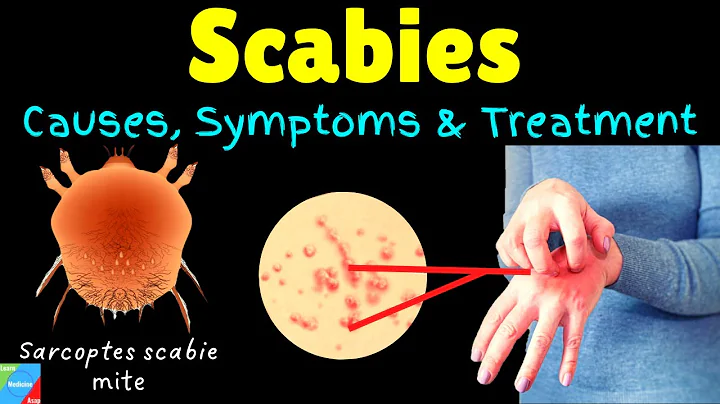 Scabies: Causes, Symptoms, Diagnosis, Treatment & Prevention