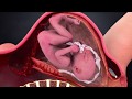 Uterine Rupture Explained by a Lawyer