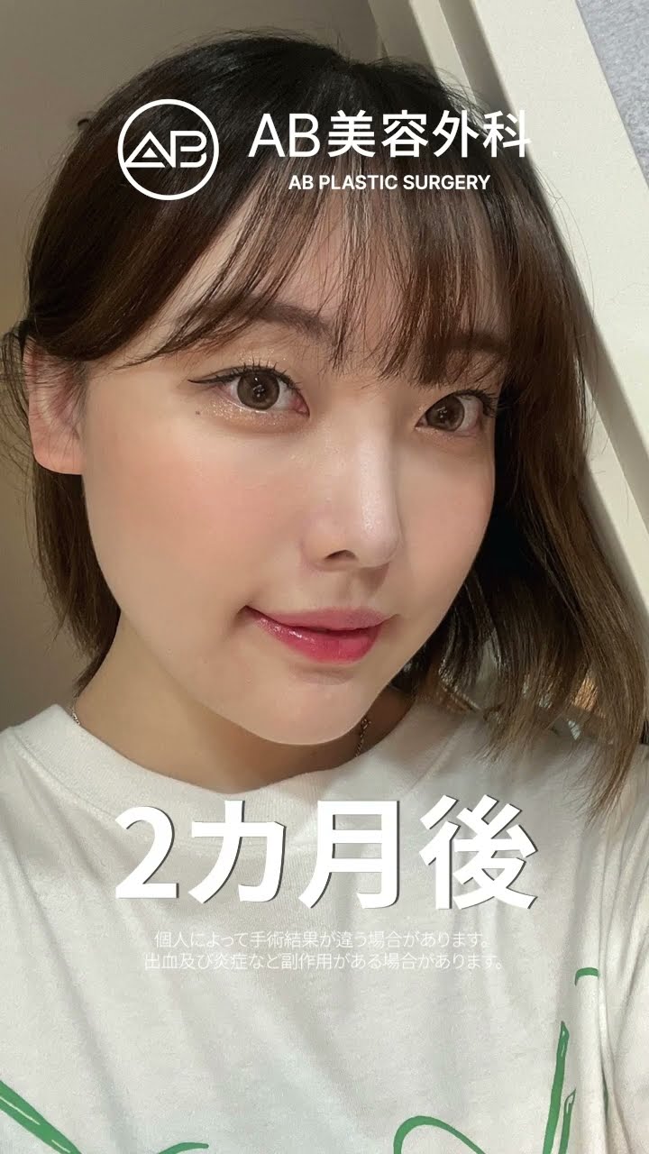 「顎と鼻の整形で大変身！可愛いから美しいへ😍✨信じられないビフォーアフター！」#おすすめ #ビフォーアフター #韓国整形