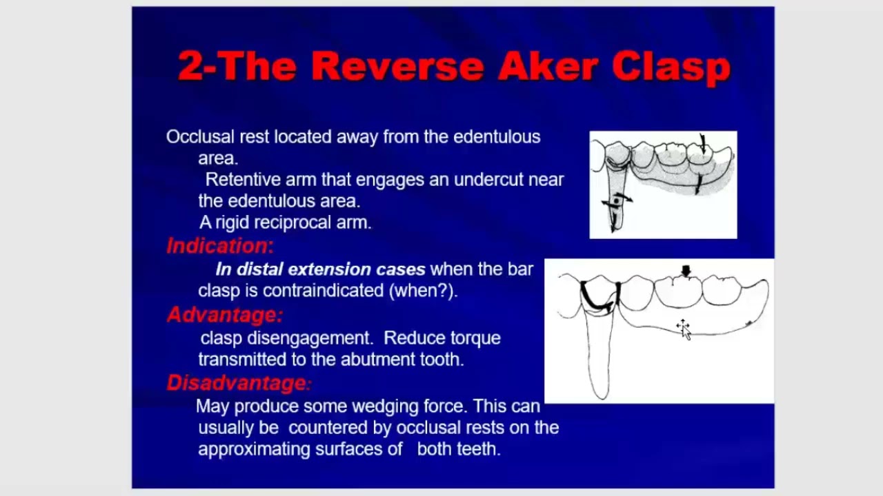 Removable 2 - Direct retention
