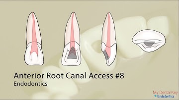 PASS THE CDCA - Anterior Endo Access | My Dental Key