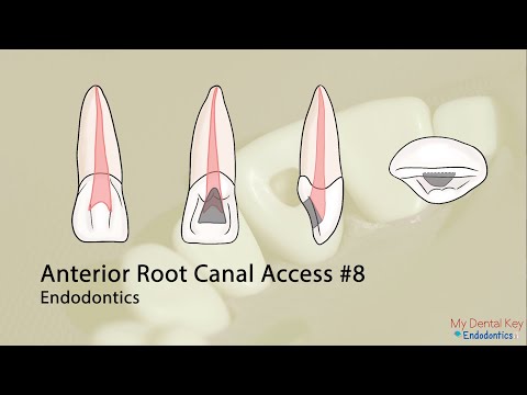 PASS THE CDCA - Anterior Endo Access | My Dental Key