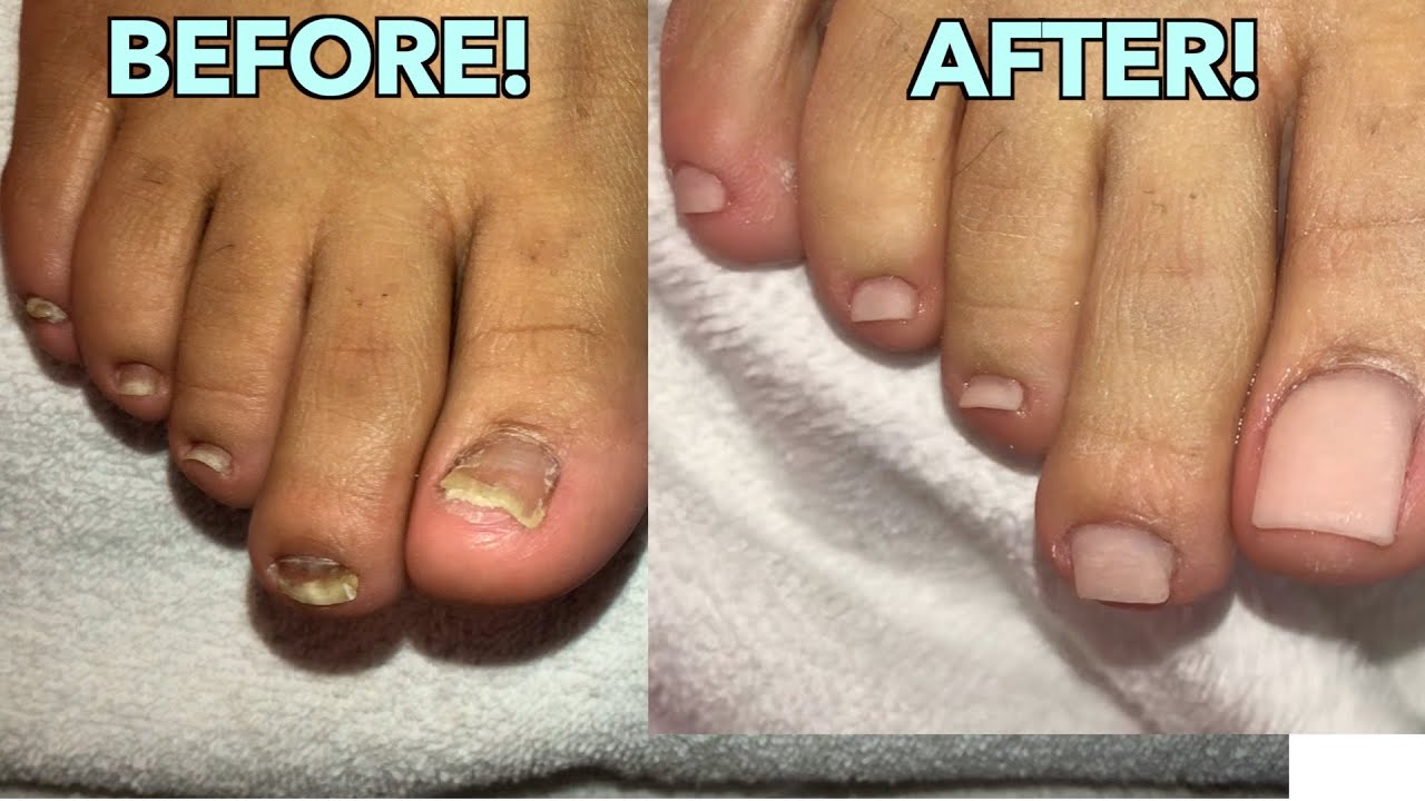 What Is Onychomycosis (Nail Fungus), and What Does It Look Like? - GoodRx