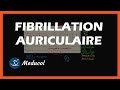 La Fibrillation Auriculaire: Définition et Symptômes