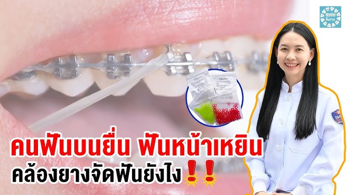 ทำไมหมอต้องให้คล้องยางจัดฟัน ดึงยางจัดฟันยังไงต้องดูคลิปนี้ - Youtube