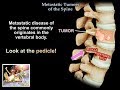 Metastatic Tumors Of The Spine  - Everything You Need To Know - Dr. Nabil Ebraheim