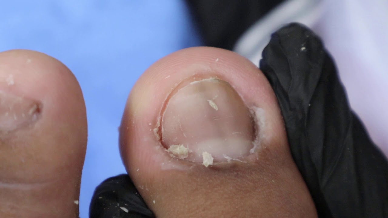Ep_827 Foot skin nail removal ðŸ‘£ à¸­à¸±à¸™à¸™à¸µà¹‰à¸„à¸·à¸­à¸«à¸™à¸±à¸‡à¸„à¸±à¸™à¸‚à¹‰à¸²à¸‡à¹€à¸¥à¹‡à¸šà¸Šà¸´à¹‰à¸™à¸«à¸¢à¹ˆà¸²à¸¢à¸¢ ðŸ˜�  (This clip from Thailand)
