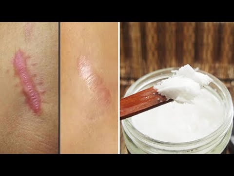 Video: Cicatricele Eczemelor: 10 Remedii Casnice De încercat