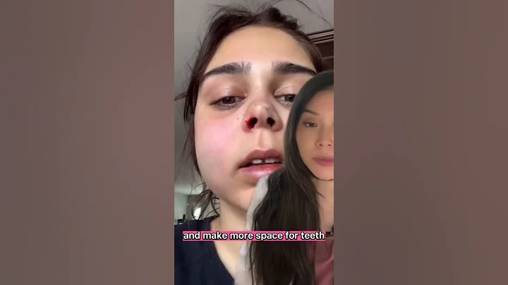 Orthodontist creates huge tooth gap! #gaptoothnation #gaptooth #expander