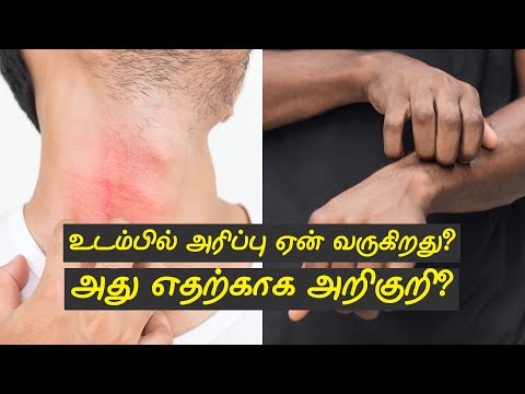 மழைக்காலத்தில் ஏன் அதிகமாக உடம்பில் அரிப்பு வருகிறது? Why does itching occur in the body?