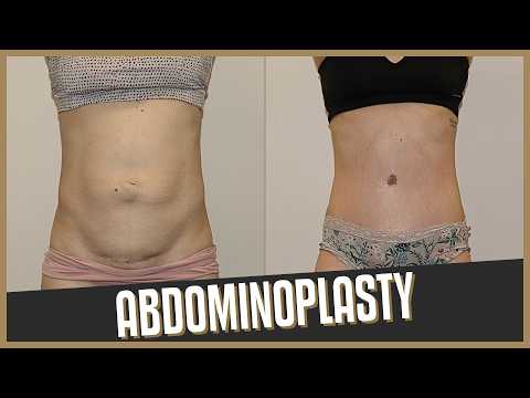 Abdominoplasty with severe Rectus Diastasis