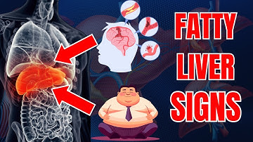 Recognizing the Symptoms of Fatty Liver Disease  | Fatty Liver Symptoms | Fatty Liver signs