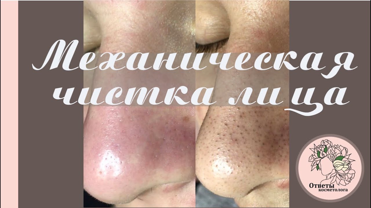 Механическая чистка лица - YouTube