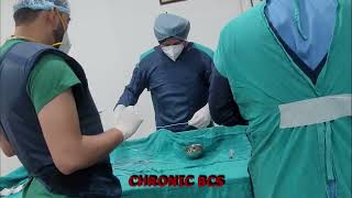 Chronic BCS