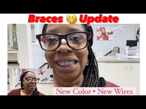 Braces ? Update | New Color & New Wires| Smile Doctors