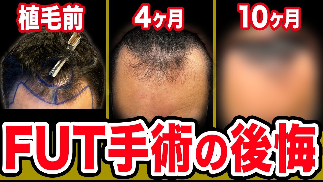 植毛2回目決定!?】FUT手術から10ヶ月経過した現状の不満を暴露！ - YouTube