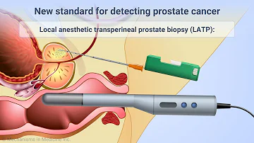 What percentage of prostate biopsies are cancer?