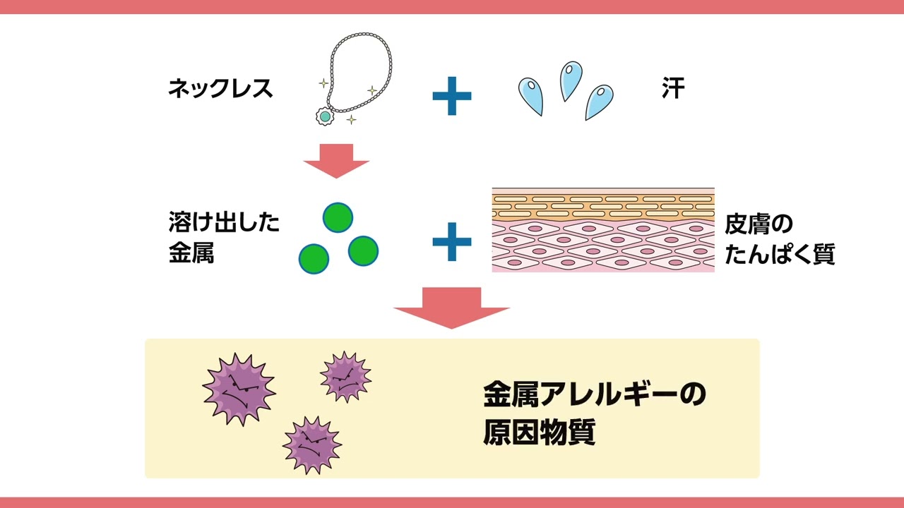 接触皮膚炎 - アレルギーポータル