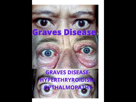 Hyperthyroidism?EVERYTHING about GRAVES disease in 10 minutes-High yield facts with MCQs-USMLE, NEET