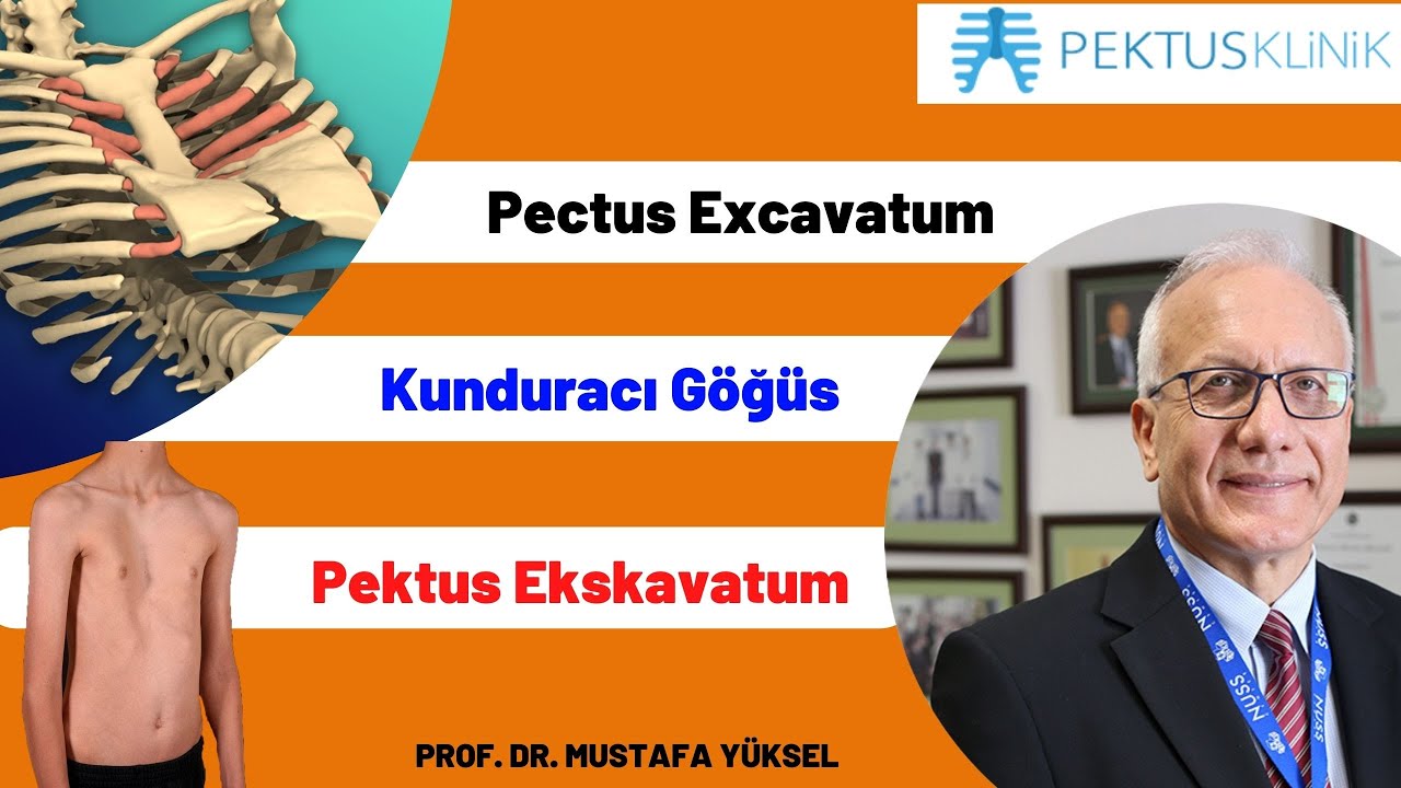Dünya Genelinde Pektus Tedavilerinin Gelişimi (PEKTUS EXCAVATUM) -Prof. Dr. Mustafa Yüksel