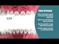 Types of Retainers | Retainer Wear Part 2