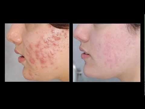 Acne Vulgaris