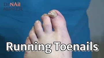 Do runners toenails fall off?  Running Nails. Throwback