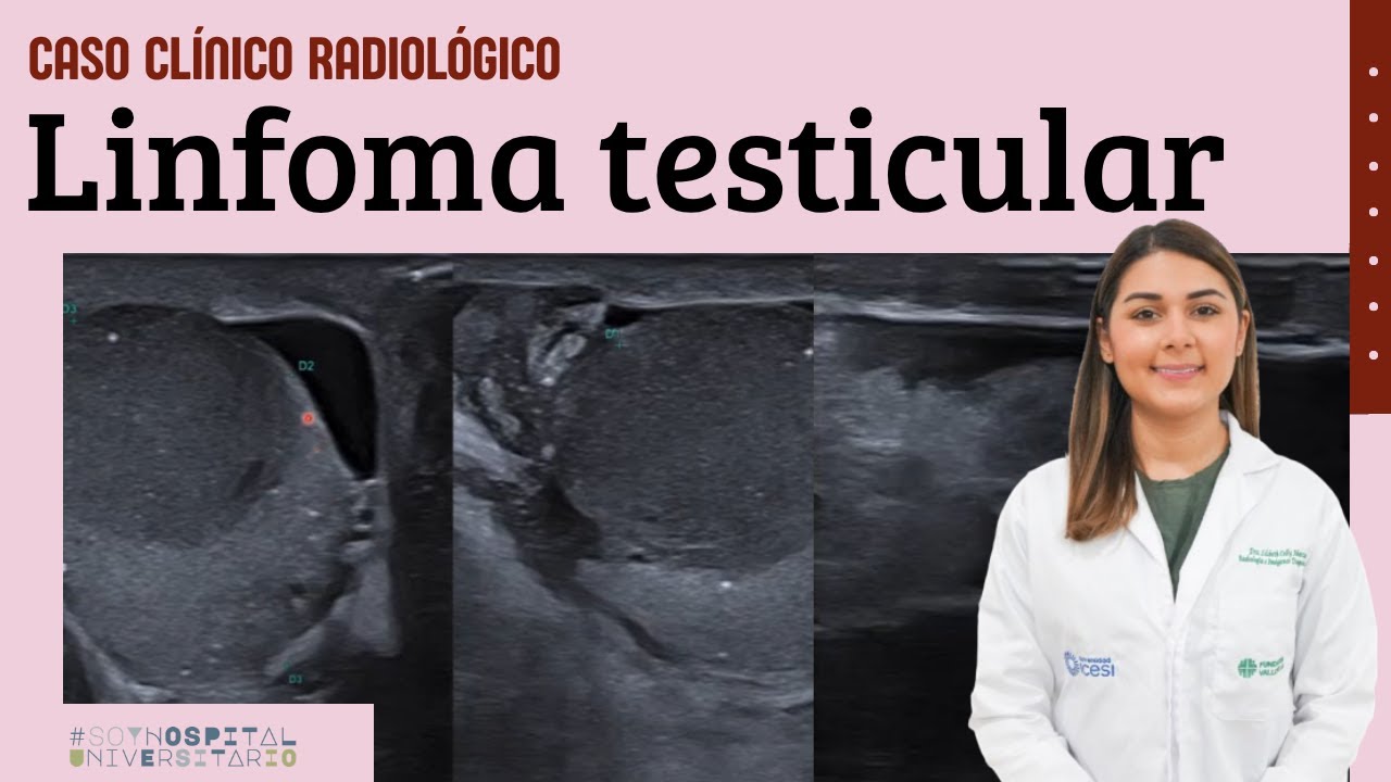 Caso clínico 131: Linfoma testicular