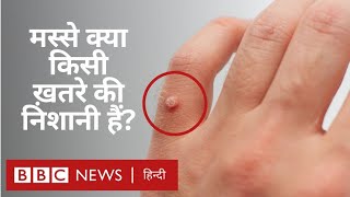 Download Lagu मस्से क्यों हो जाते हैं और उन्हें कैसे हटाया जा सकता है? - Fit Zindagi (BBC Hindi) Download Lagu मस्से क्यों हो जाते हैं और उन्हें कैसे हटाया जा सकता है? - Fit Zindagi (BBC Hindi)