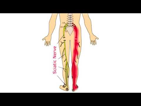 What Causes Sciatica and Can You Get Rid of It?  Sciatica Explained in 4 minutes.